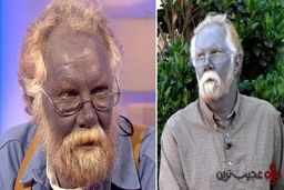 مردی با پوست آبی رنگ (عکس)