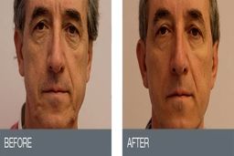 لیفت صورت با نخ چقدر طول می کشد؟