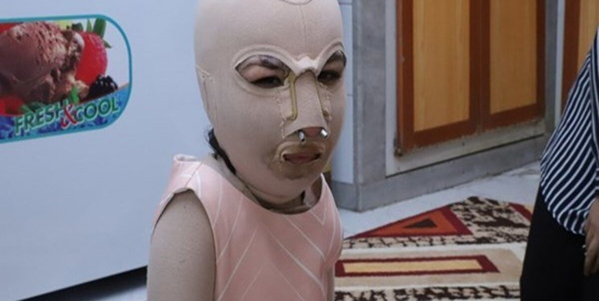 زندگی غمبار دختری که پدر و مادرش زنده زنده سوختند؛ تصاویر