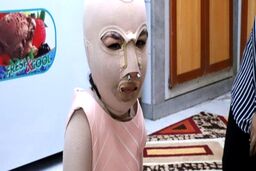 زندگی غمبار دختری که پدر و مادرش زنده زنده سوختند؛ تصاویر