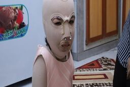 زندگی غمبار دختری که پدر و مادرش زنده زنده سوختند؛ تصاویر